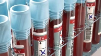 AIDS nedir? HIV virüsü, AIDS belirtileri ve tedavi yöntemleri nelerdir?